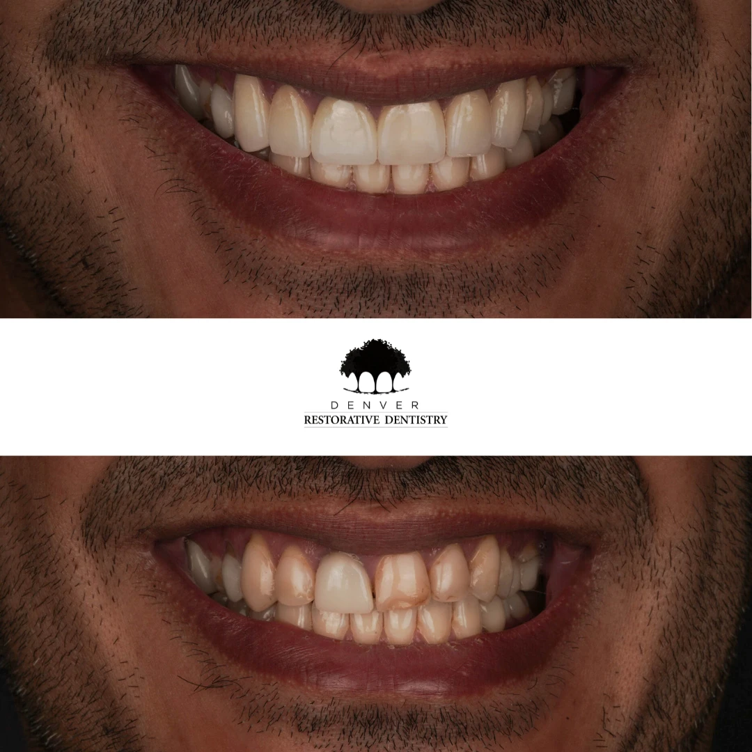 crown-veneers gallery